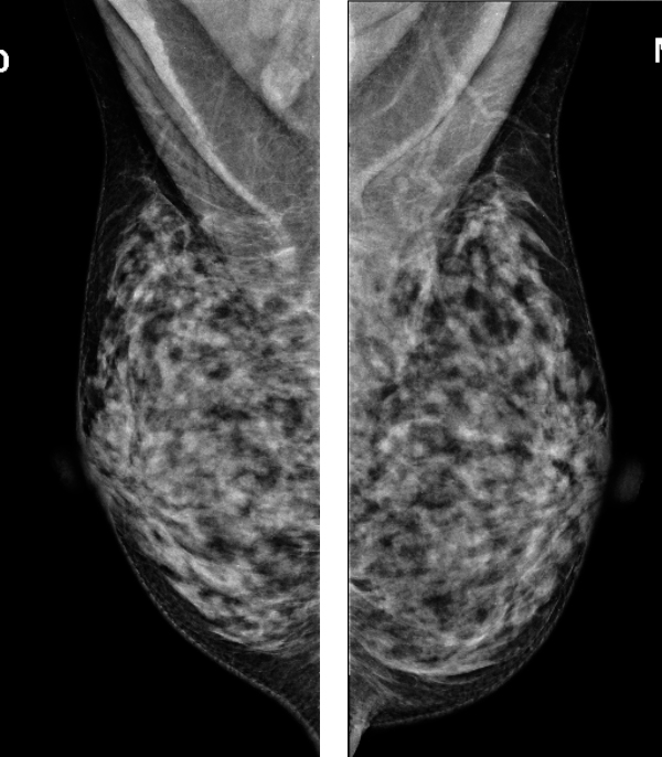 Como Entender O Resultado Da Minha Mamografia Veja Rio