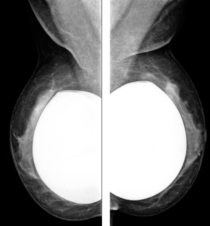 Alteração pós-mamoplastia bilateral (implantes). Categoria BI-RADS® 2.
