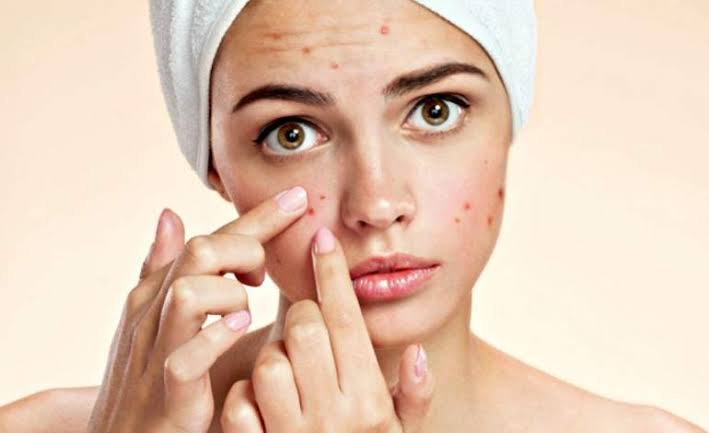 Saiba tudo sobre o tratamento de acne com Roacutan