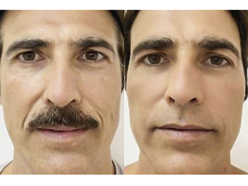 Bioestimulação de colágeno: Gianecchinni e a lição de beleza masculina