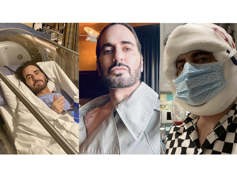 Marc Jacobs quebra tabu ao revelar nas redes cirurgia plástica