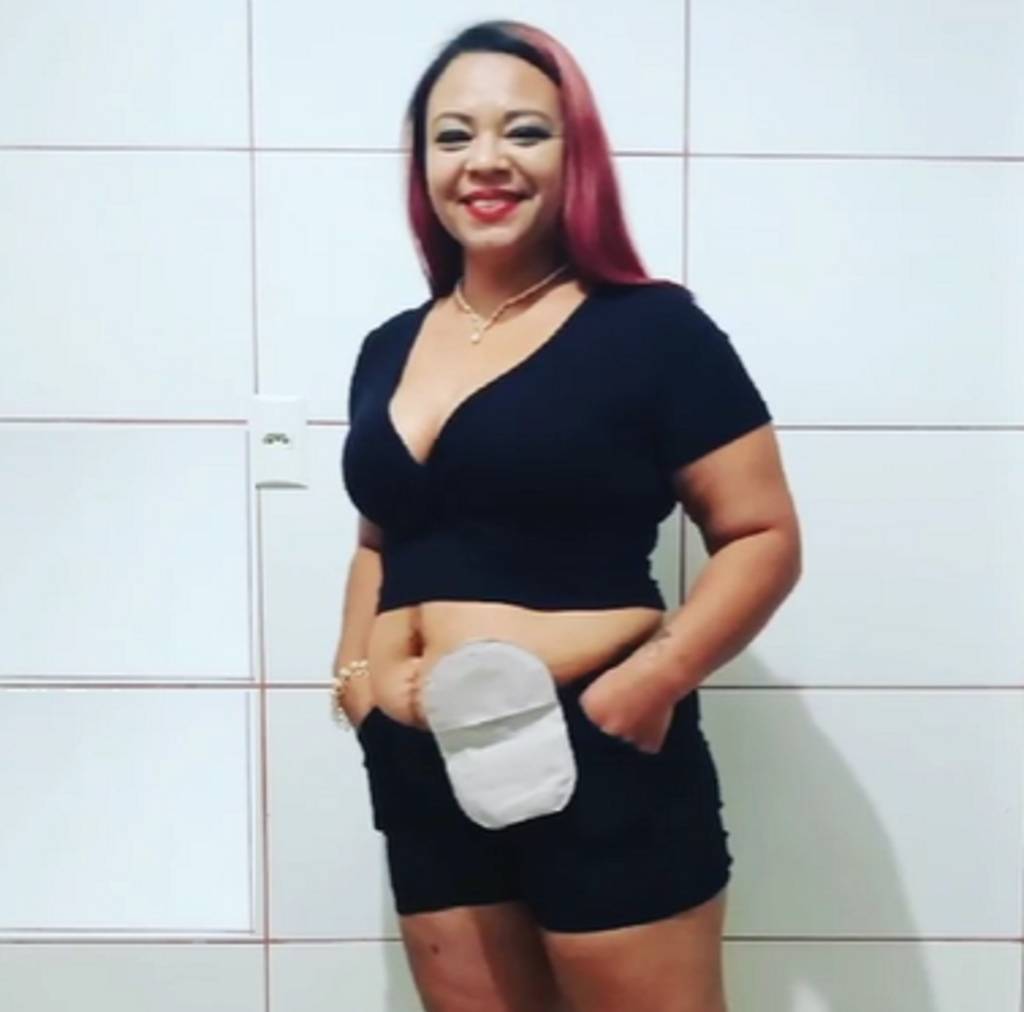 Foto mostra mulher branca com cabelos vermelhos e roupa preta com bolsa de colostomia