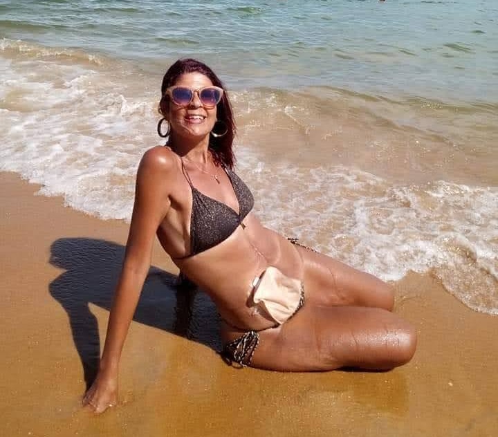 Foto mostra mulher bronzeada na praia usando biquini, óculos escuros e com uma bolsa de colostomia