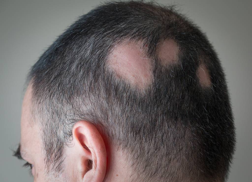 Alopecia Aerata – Spot Baldness alopesia