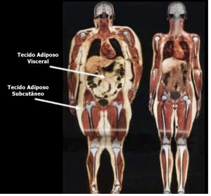 Ressonância magnética demonstrando depósitos de gordura na obesidade no tecido adiposo subcutâneo e no tecido adiposo visceral.
