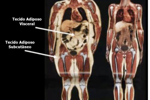 Ressonância magnética demonstrando depósitos de gordura na obesidade no tecido adiposo subcutâneo e no tecido adiposo visceral.