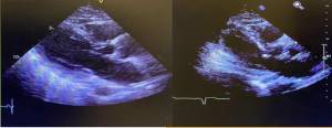 Ecocardiograma da esquerda de uma paciente com a Síndrome do Coração partido. Ecocardiograma da direita demonstrando recuperação da Síndrome do Coração Partido 20 dias depois.