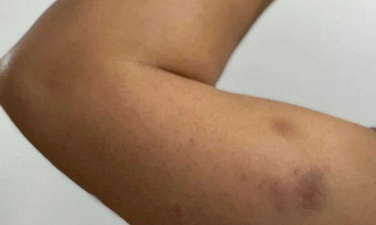 Foto mostra braço com hematomas
