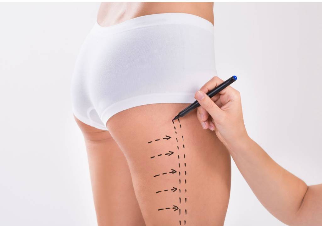 Muito além do abdômen: Lipoaspiração em várias partes do corpo