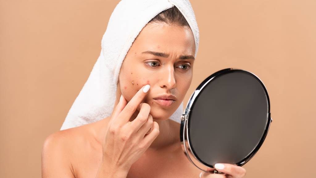 A acne e seus desafios