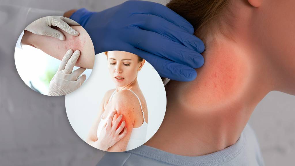 À flor da pele: o que é e como tratar a dermatite atópica